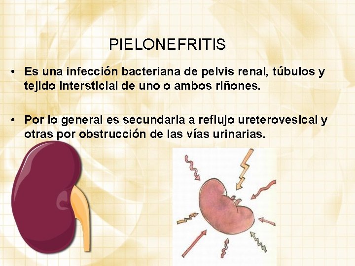 PIELONEFRITIS • Es una infección bacteriana de pelvis renal, túbulos y tejido intersticial de