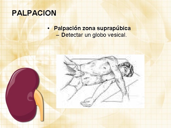 PALPACION • Palpación zona suprapúbica – Detectar un globo vesical. 