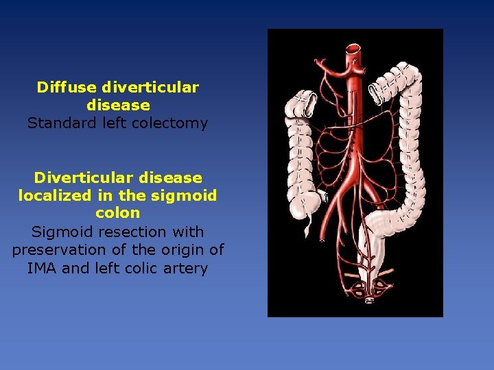 Diffuse diverticular disease Standard left colectomy Diverticular disease localized in the sigmoid colon Sigmoid