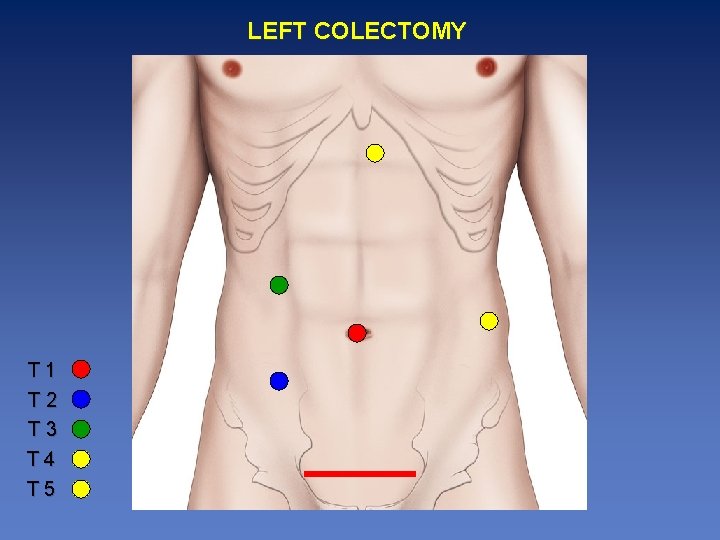 LEFT COLECTOMY T 1 T 2 T 3 T 4 T 5 