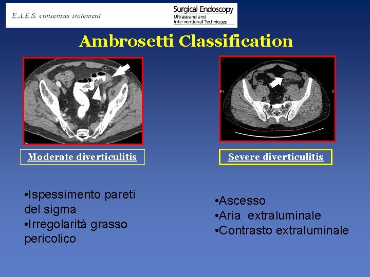 Ambrosetti Classification Moderate diverticulitis • Ispessimento pareti del sigma • Irregolarità grasso pericolico Severe