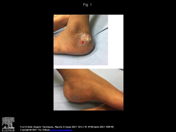Fig. 1 Foot & Ankle Surgery: Techniques, Reports & Cases 2021 1 DOI: (10.