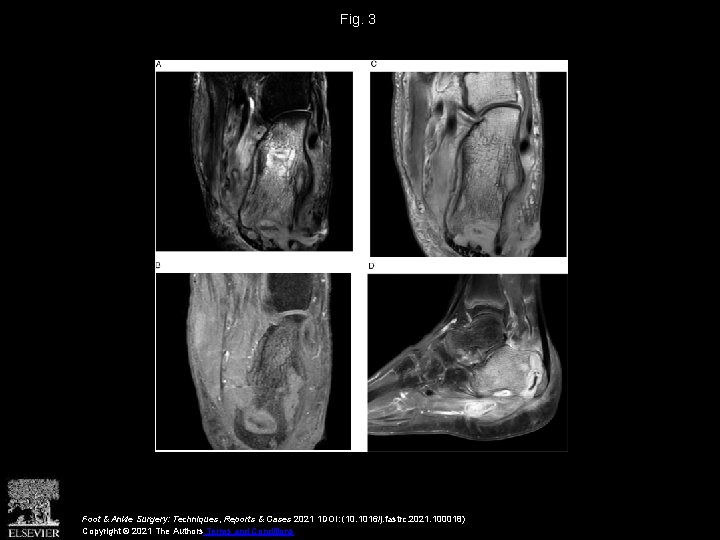 Fig. 3 Foot & Ankle Surgery: Techniques, Reports & Cases 2021 1 DOI: (10.