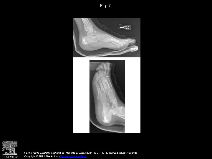 Fig. 7 Foot & Ankle Surgery: Techniques, Reports & Cases 2021 1 DOI: (10.