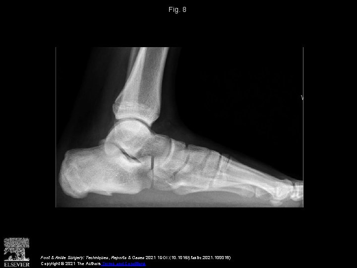 Fig. 8 Foot & Ankle Surgery: Techniques, Reports & Cases 2021 1 DOI: (10.