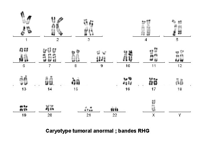Caryotype tumoral anormal ; bandes RHG 