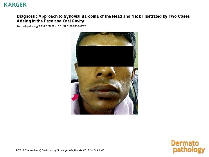 Diagnostic Approach to Synovial Sarcoma of the Head and Neck Illustrated by Two Cases
