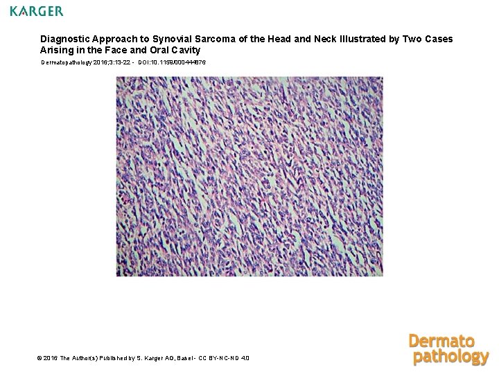 Diagnostic Approach to Synovial Sarcoma of the Head and Neck Illustrated by Two Cases