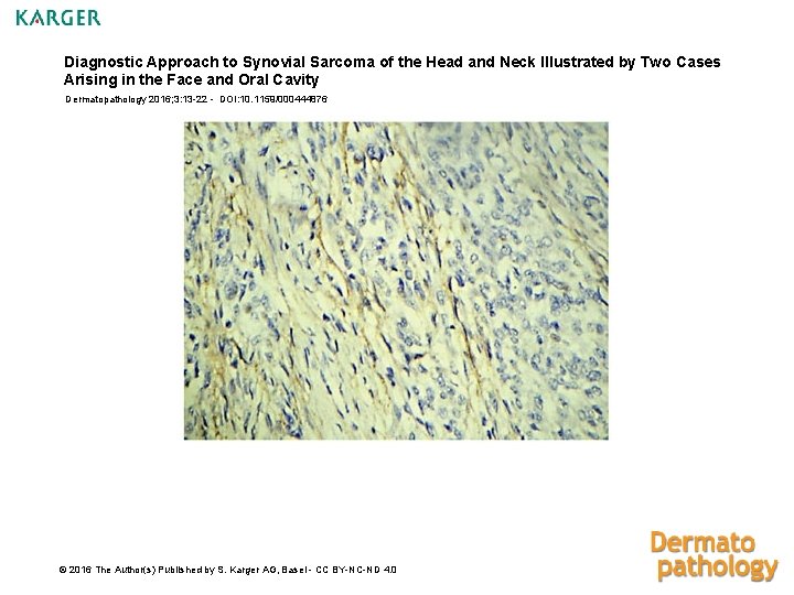 Diagnostic Approach to Synovial Sarcoma of the Head and Neck Illustrated by Two Cases