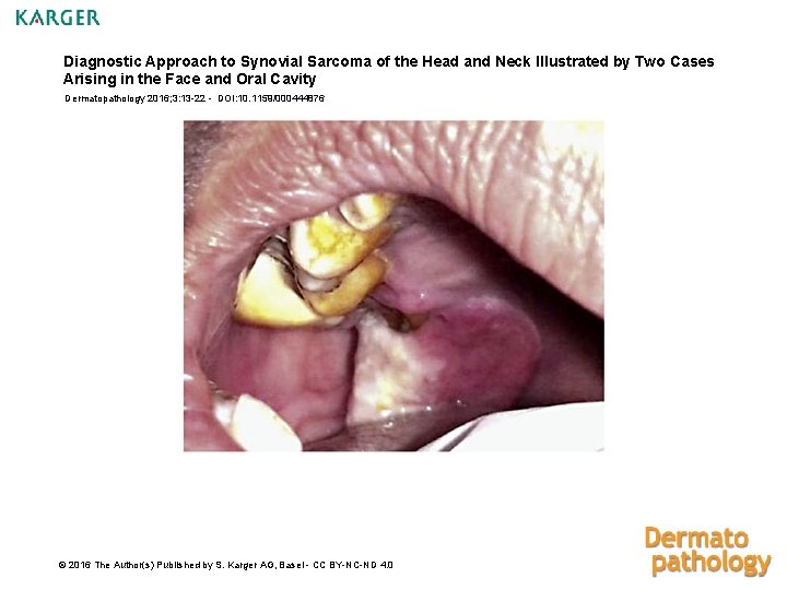 Diagnostic Approach to Synovial Sarcoma of the Head and Neck Illustrated by Two Cases