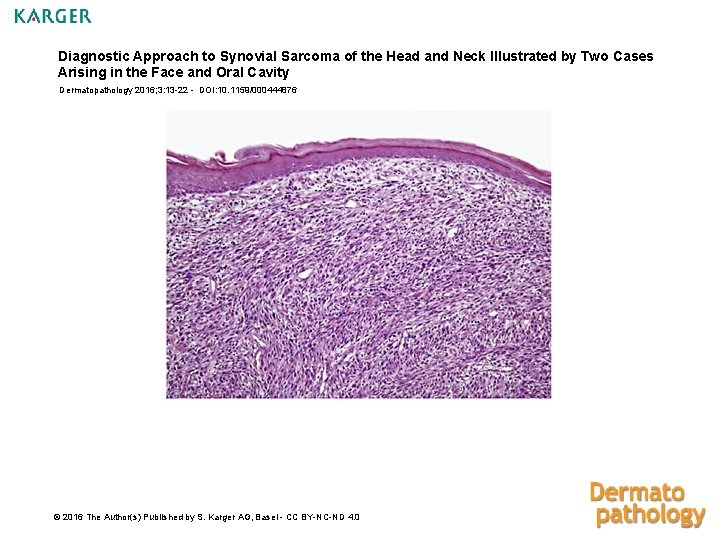 Diagnostic Approach to Synovial Sarcoma of the Head and Neck Illustrated by Two Cases