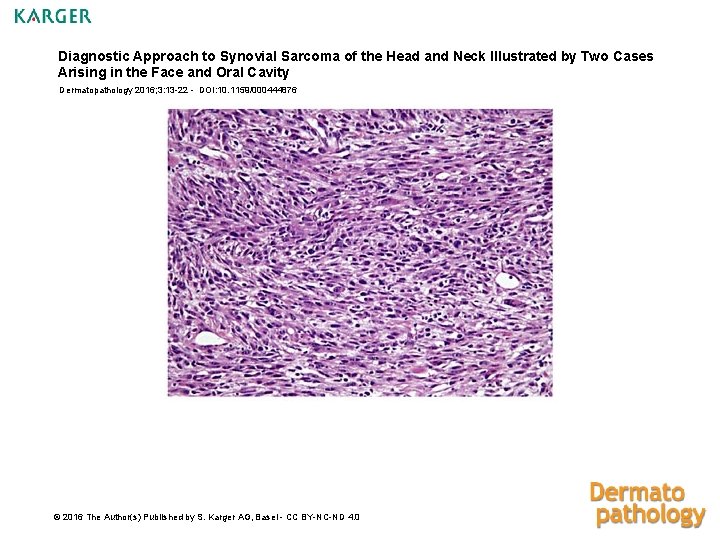 Diagnostic Approach to Synovial Sarcoma of the Head and Neck Illustrated by Two Cases