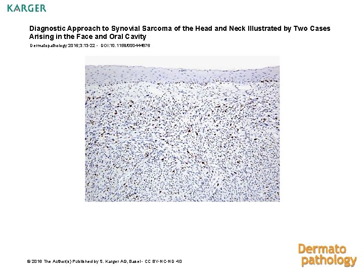 Diagnostic Approach to Synovial Sarcoma of the Head and Neck Illustrated by Two Cases