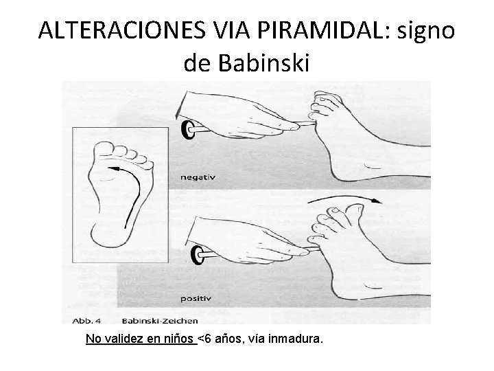 ALTERACIONES VIA PIRAMIDAL: signo de Babinski No validez en niños <6 años, vía inmadura.