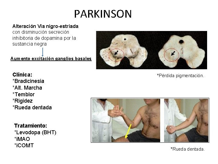 PARKINSON Alteración Via nigro-estriada con disminución secreción inhibitoria de dopamina por la sustancia negra