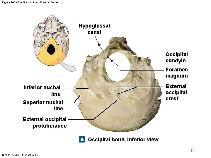 Figure 7– 5 a The Occipital and Parietal Bones. Hypoglossal canal Occipital condyle Foramen