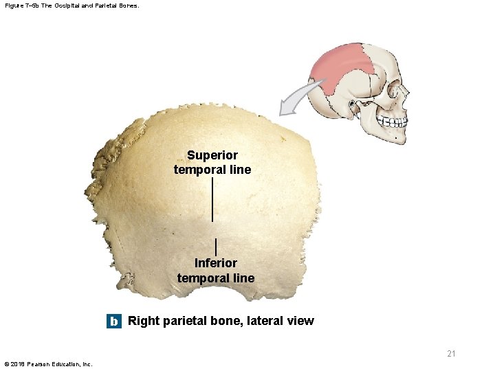 Figure 7– 5 b The Occipital and Parietal Bones. Superior temporal line Inferior temporal