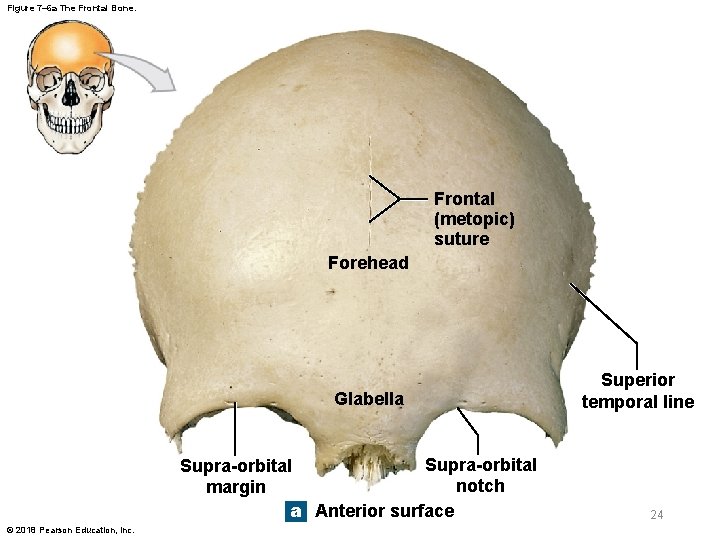 Figure 7– 6 a The Frontal Bone. Frontal (metopic) suture Forehead Glabella Supra-orbital notch