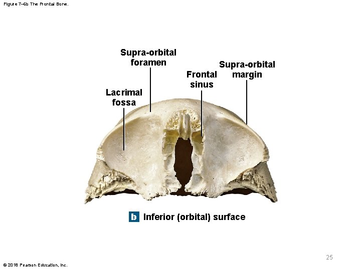 Figure 7– 6 b The Frontal Bone. Supra-orbital foramen Lacrimal fossa Supra-orbital margin Frontal