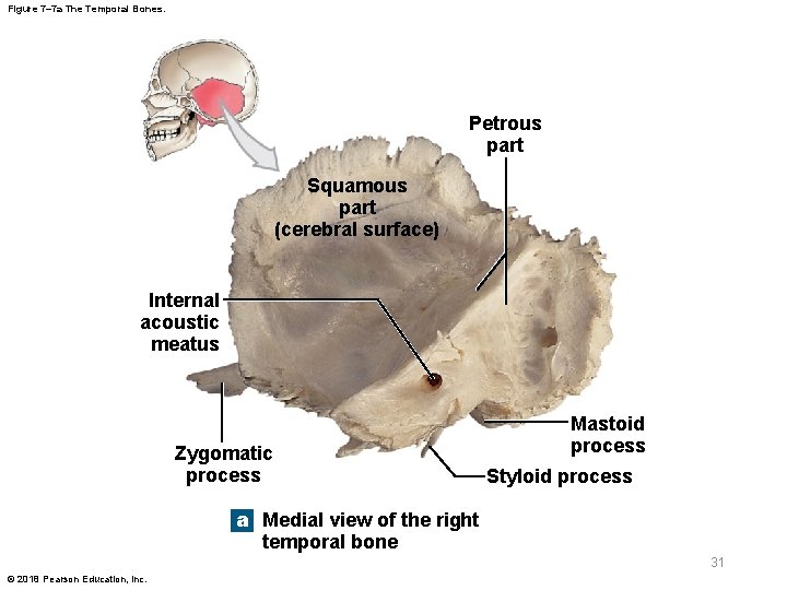 Figure 7– 7 a The Temporal Bones. Petrous part Squamous part (cerebral surface) Internal