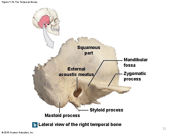 Figure 7– 7 b The Temporal Bones. Squamous part External acoustic meatus Mandibular fossa