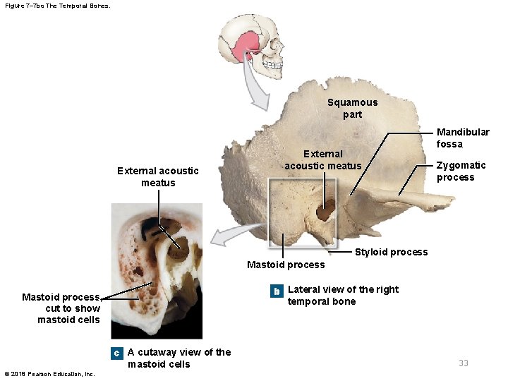 Figure 7– 7 bc The Temporal Bones. Squamous part External acoustic meatus Mandibular fossa