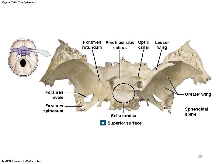 Figure 7– 8 a The Sphenoid. Foramen Prechiasmatic Optic canal rotundum sulcus Foramen ovale