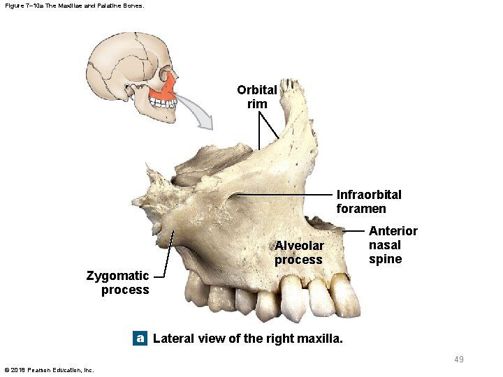 Figure 7– 10 a The Maxillae and Palatine Bones. Orbital rim Infraorbital foramen Alveolar