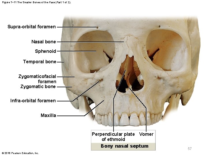 Figure 7– 11 The Smaller Bones of the Face (Part 1 of 2). Supra-orbital