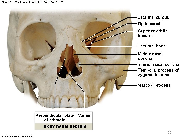 Figure 7– 11 The Smaller Bones of the Face (Part 2 of 2). Lacrimal