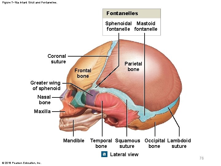 Figure 7– 16 a Infant Skull and Fontanelles Sphenoidal Mastoid fontanelle Coronal suture Frontal