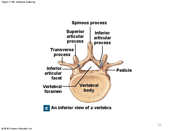 Figure 7– 18 c Vertebral Anatomy. Spinous process Superior articular process Inferior articular process