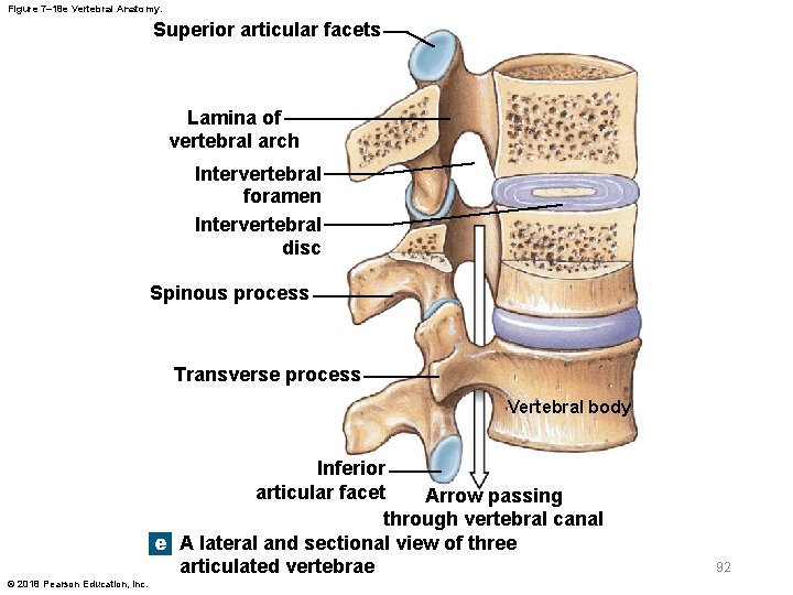 Figure 7– 18 e Vertebral Anatomy. Superior articular facets Lamina of vertebral arch Intervertebral