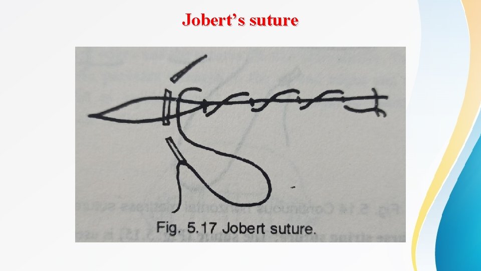 Jobert’s suture 
