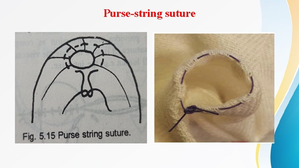 Purse-string suture 