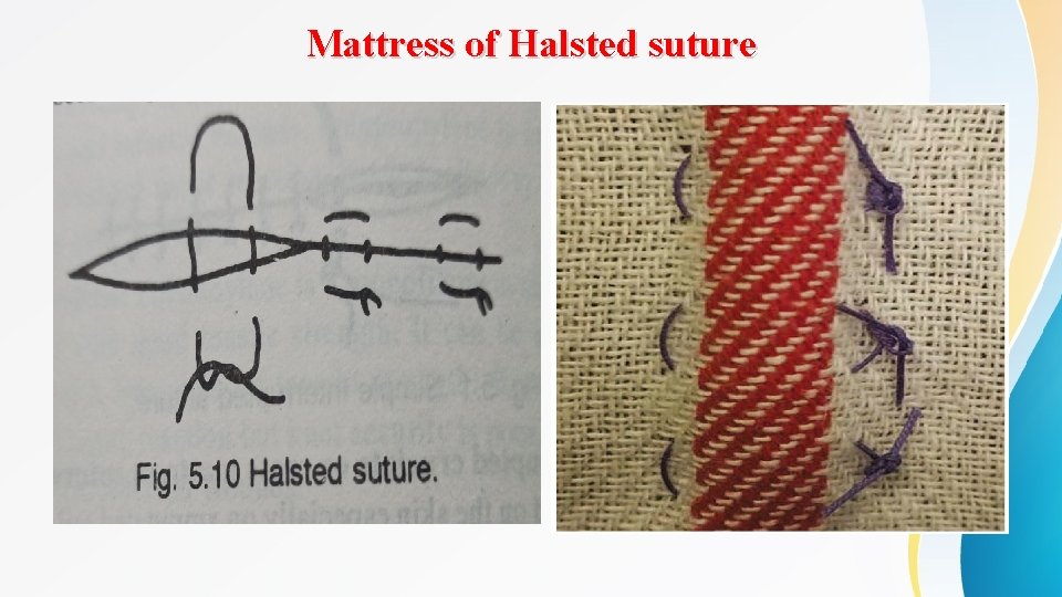 Mattress of Halsted suture 