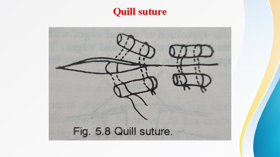 Quill suture 