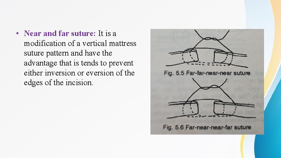  • Near and far suture: It is a modification of a vertical mattress
