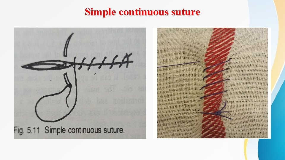 Simple continuous suture 
