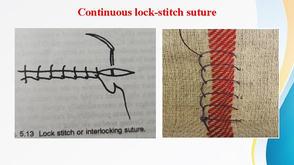 Continuous lock-stitch suture 
