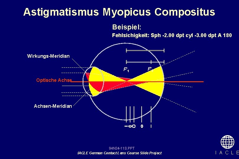 Astigmatismus Myopicus Compositus Beispiel: Fehlsichigkeit: Sph -2. 00 dpt cyl -3. 00 dpt A