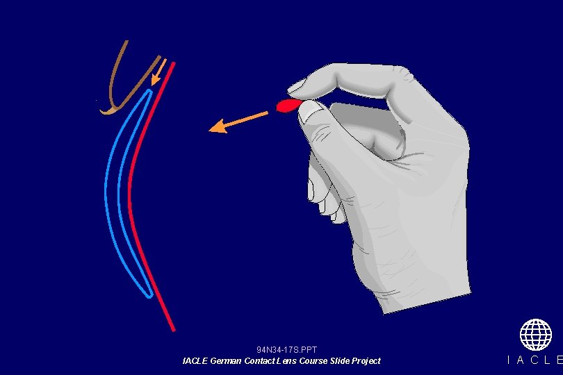 94 N 34 -17 S. PPT IACLE German Contact Lens Course Slide Project I