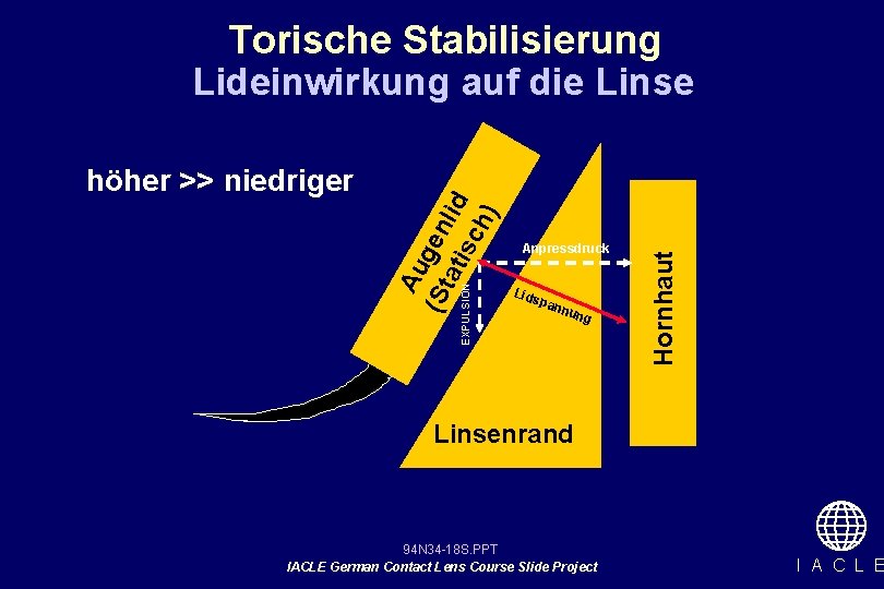 Torische Stabilisierung Lideinwirkung auf die Linse Anpressdruck Lid spa nnu ng Hornhaut Au (St