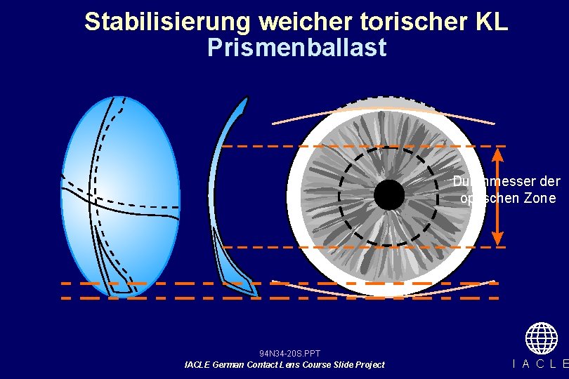 Stabilisierung weicher torischer KL Prismenballast Durchmesser der optischen Zone 94 N 34 -20 S.