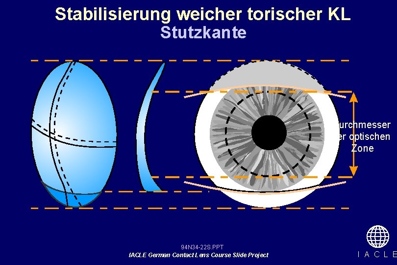 Stabilisierung weicher torischer KL Stutzkante Durchmesser der optischen Zone 94 N 34 -22 S.