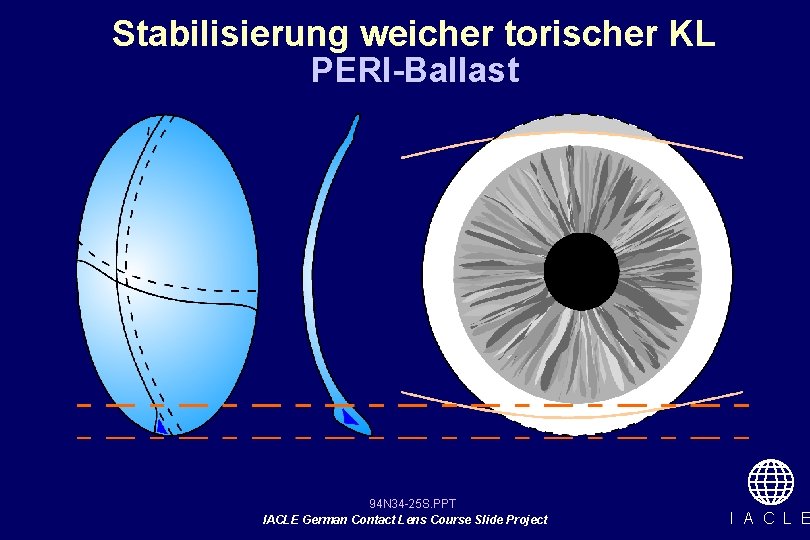 Stabilisierung weicher torischer KL PERI-Ballast 94 N 34 -25 S. PPT IACLE German Contact