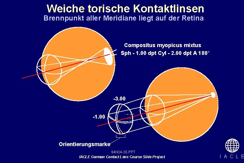 Weiche torische Kontaktlinsen Brennpunkt aller Meridiane liegt auf der Retina Compositus myopicus mixtus Sph