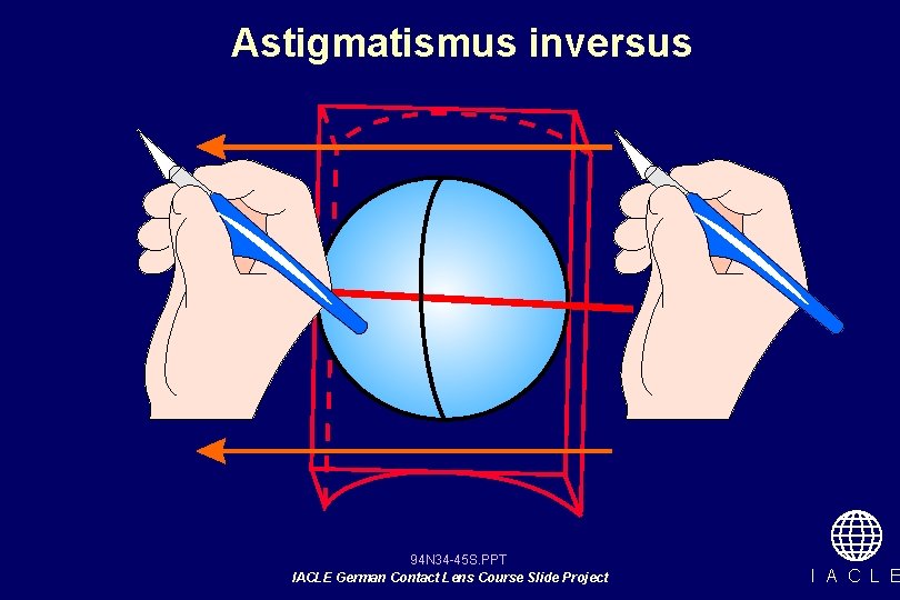 Astigmatismus inversus 94 N 34 -45 S. PPT IACLE German Contact Lens Course Slide