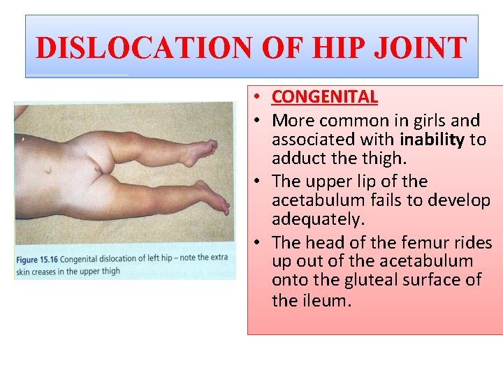 DISLOCATION OF HIP JOINT • CONGENITAL • More common in girls and associated with