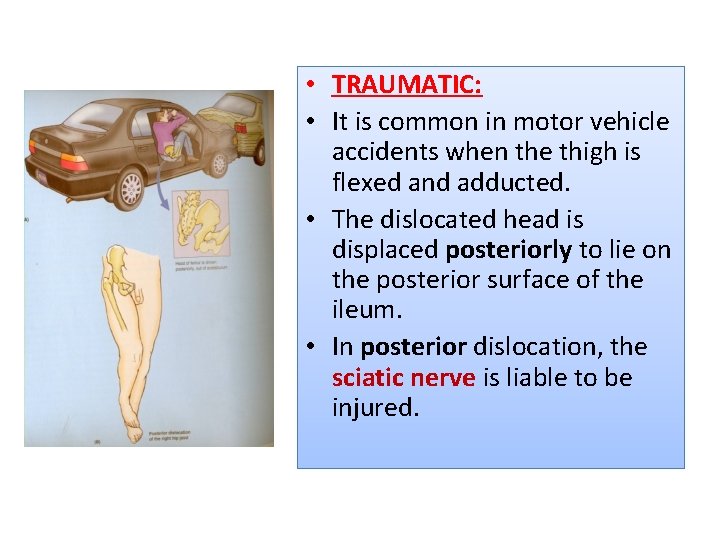  • TRAUMATIC: • It is common in motor vehicle accidents when the thigh